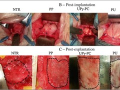 Vaginal Hysterectomy Surgery In ankleshwar                        